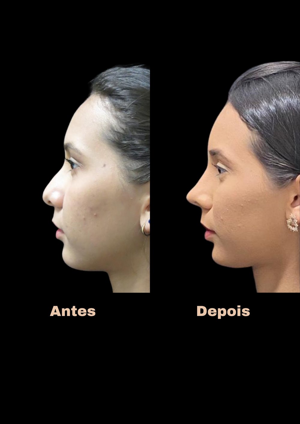 Antes e depois de rinoplastia, vista de perfil