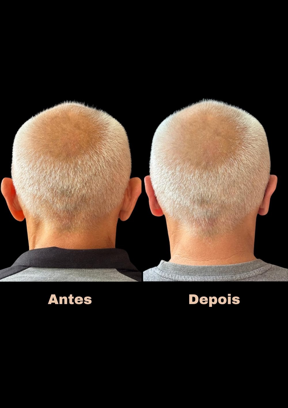 Antes e depois de otoplastia, vista posterior