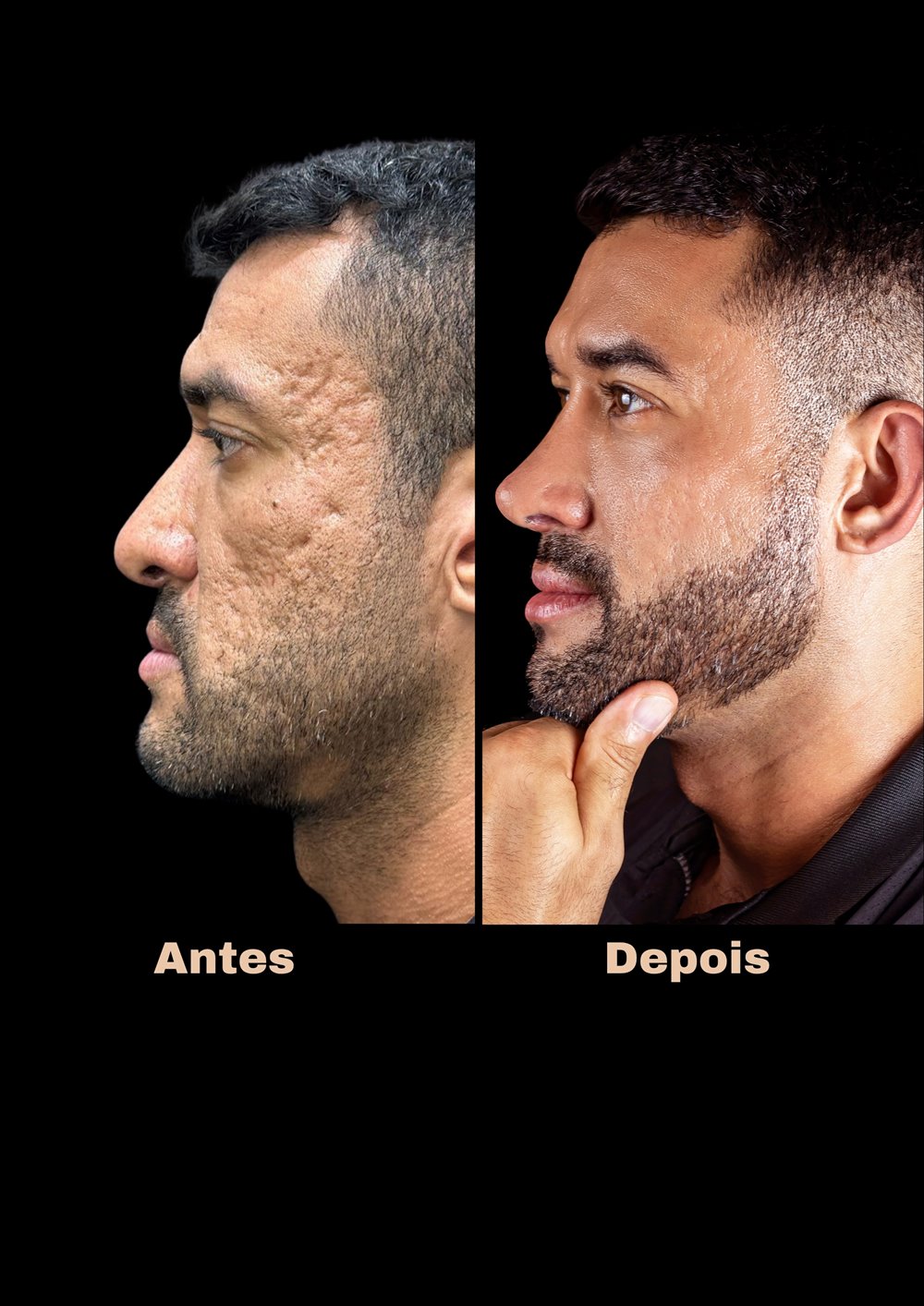 Antes e depois de rinoplastia, vista de perfil