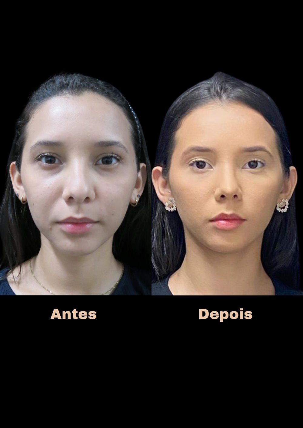 Antes e depois de rinoplastia, vista frontal