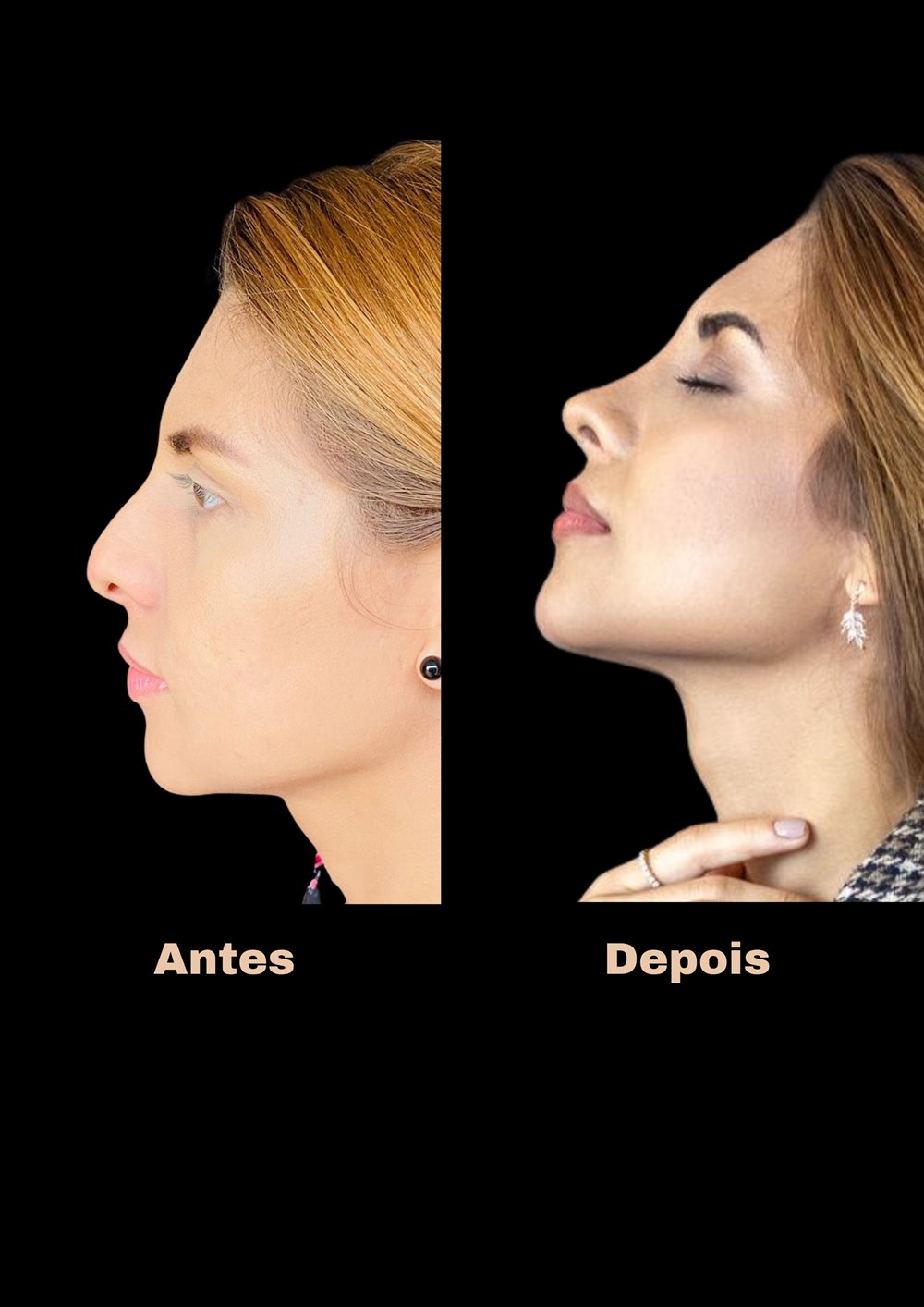 Antes e depois de rinosseptoplastia, vista de perfil