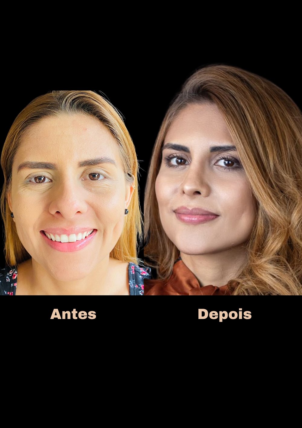 Antes e depois de rinosseptoplastia, vista frontal