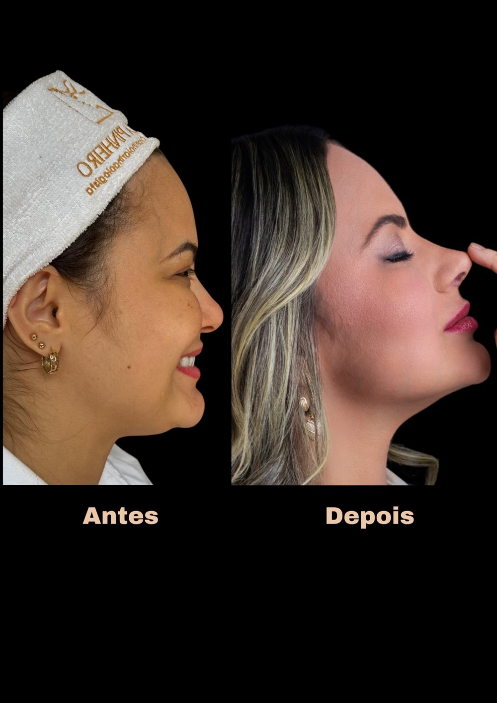 Antes e depois de rinoplastia, vista de perfil