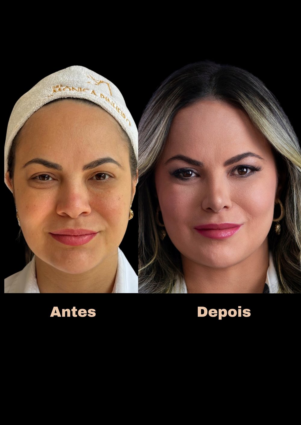 Antes e depois de rinoplastia, vista frontal
