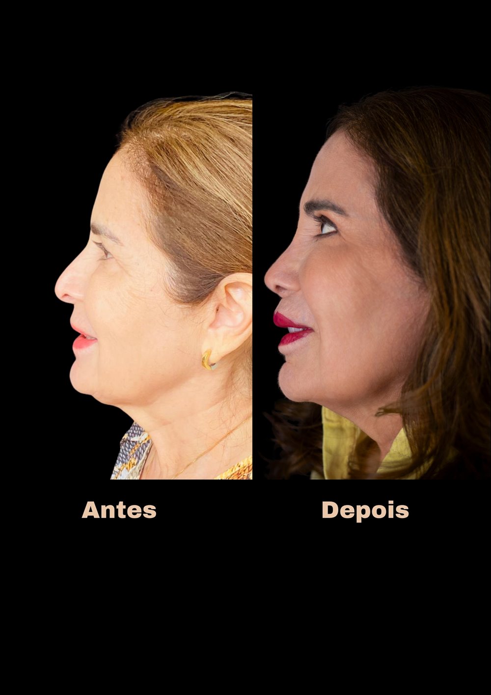 Antes e depois de rinoplastia, vista de perfil