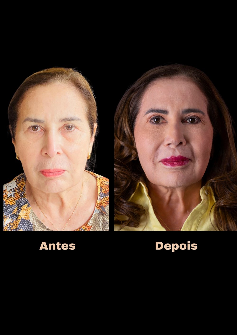 Antes e depois de rinoplastia, vista frontal