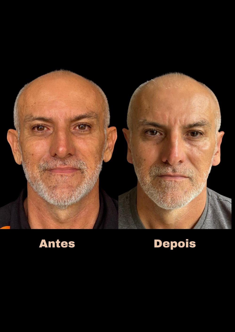 Antes e depois de otoplastia, vista frontal