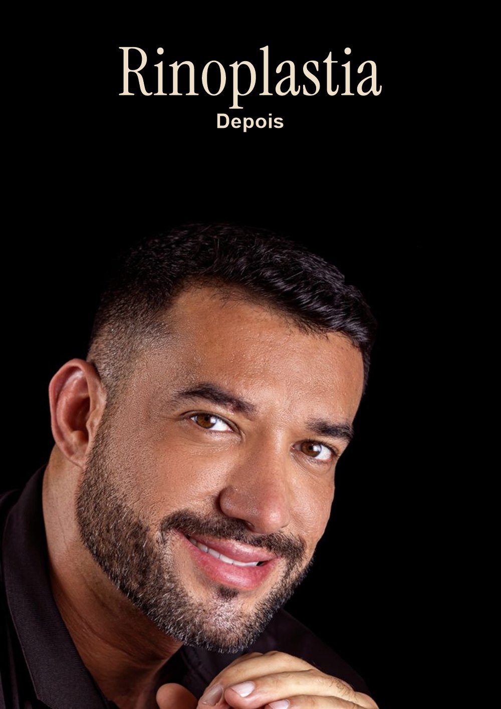 Resultado de rinoplastia masculina