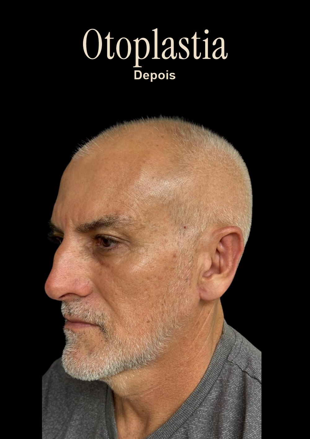 Resultado de otoplastia