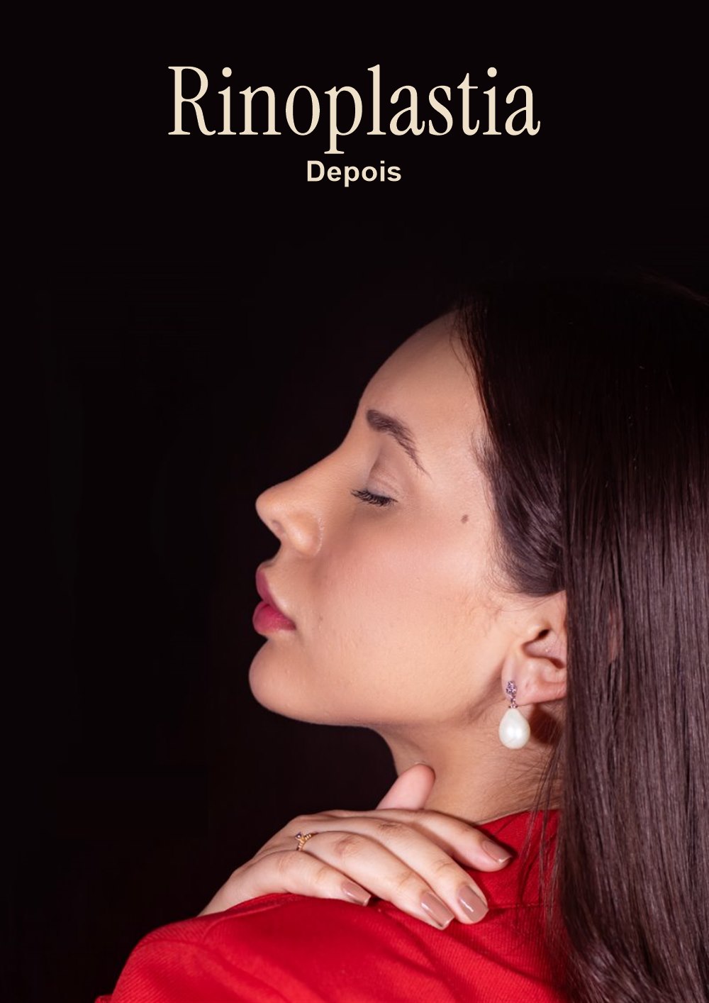 Resultado de rinoplastia